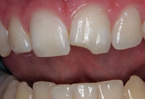 chipped tooth 81db6